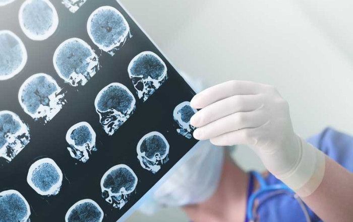 Tratamiento epilepsia Córdoba
