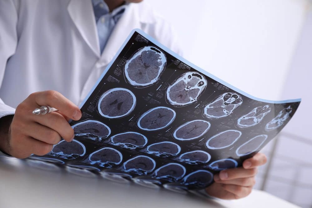 crisis epiléptica como actuar - tratamiento neurólogo