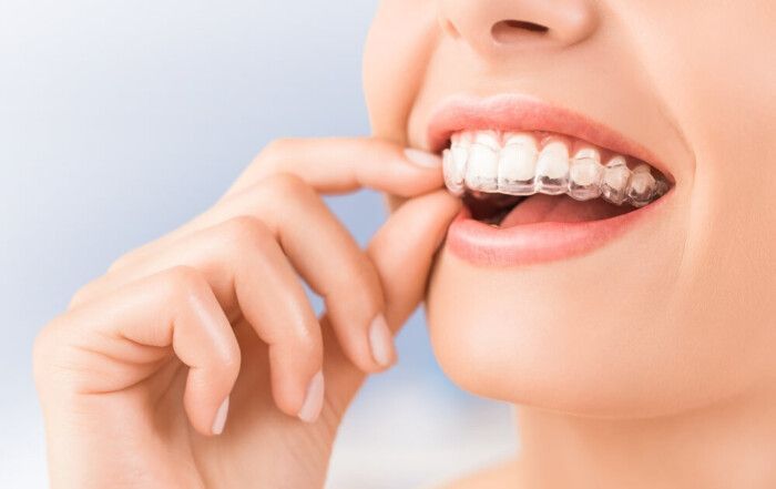 Invisalign en Córdoba: ortodoncia invisible -Dentistas expertos en Córdoba