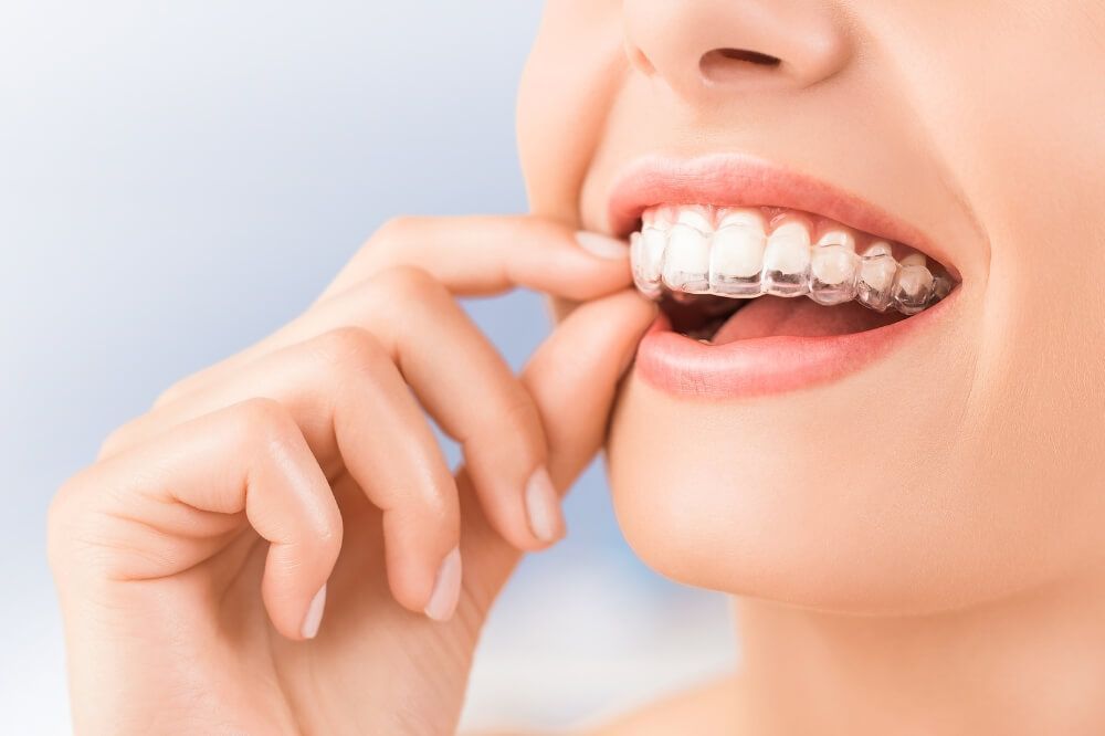 Invisalign en Córdoba: ortodoncia invisible -Dentistas expertos en Córdoba