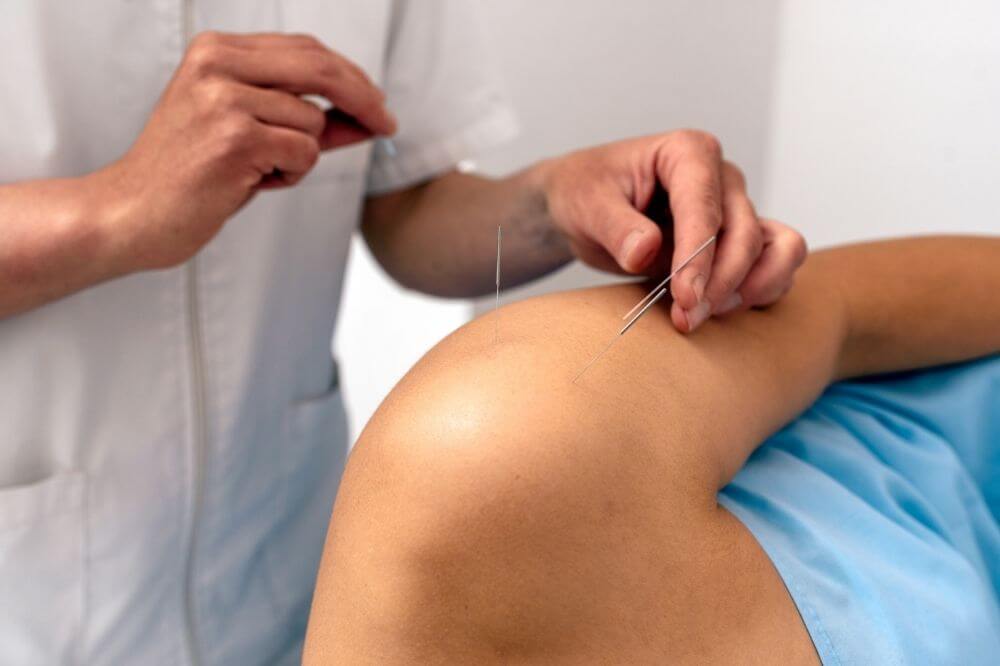 Punción seca como tratamiento del dolor muscular en fisioterapia tras accidente de tráfico