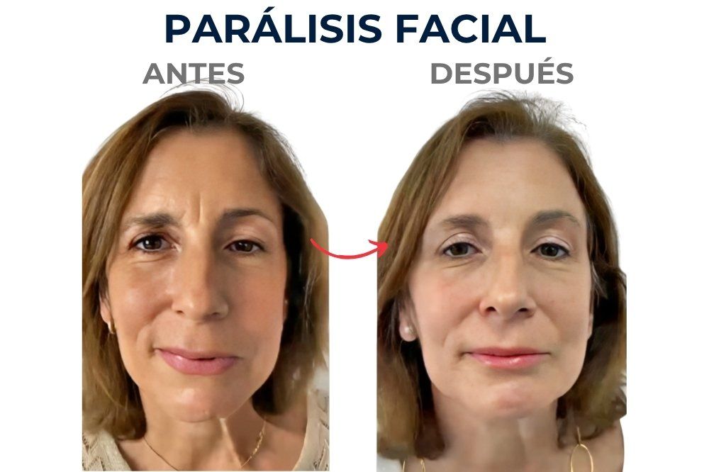 Tratamiento de parálisis facial en Córdoba - Cirujano maxilofacial en Córdoba