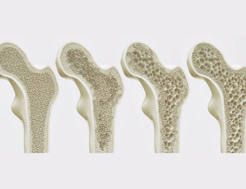Desmontando algunos mitos sobre la Osteoporosis