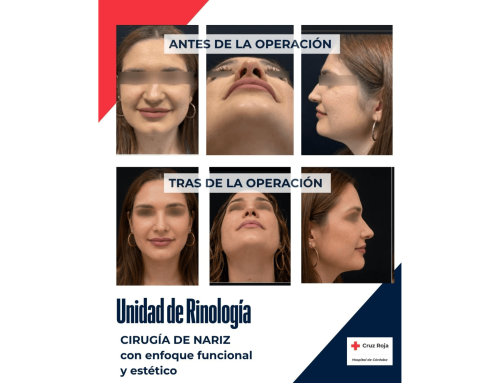 Cirugía combinada de Rinología y Cirugía Plástica para corregir la obstrucción nasal y mejorar la respiración