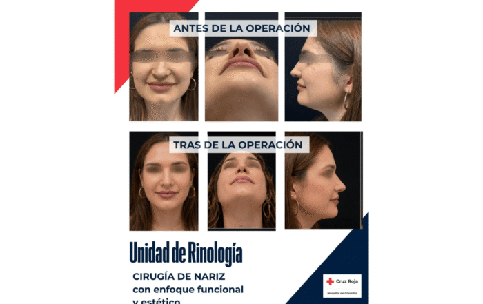 Antes y después de cirugía combinada de Rinología y Cirugía Plástica para corregir obstrucción nasal